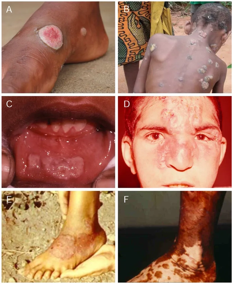 Endemic syphilis, a nonvenereal treponemal disease