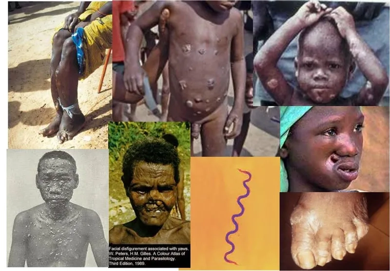 Early signs and characteristic symptoms of bejel infection