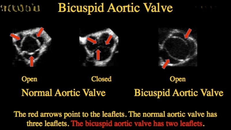 Aortic valve stenosis common in BAV patients