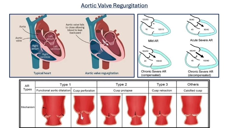 Bicuspid aortic valve genetics and family history