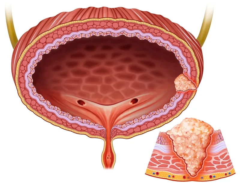 A visual guide to the stages of bladder cancer