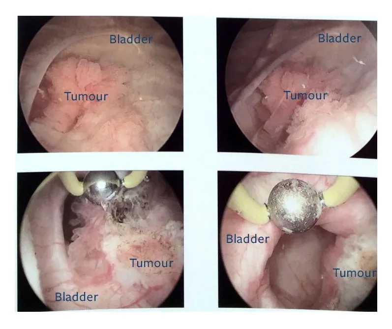 Answering the question: what is bladder cancer
