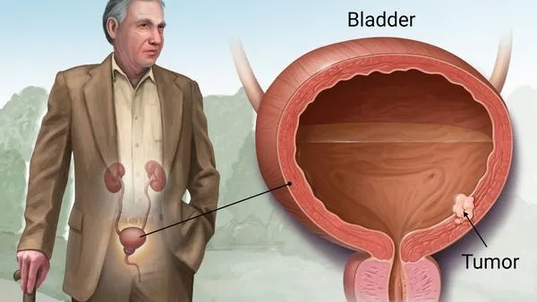Key signs of bladder cancer to watch for