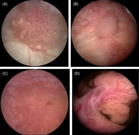 Transitional cell carcinoma, a type of bladder cancer