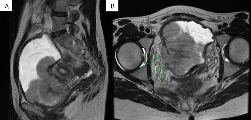 Blood in urine can be an early sign of bladder cancer
