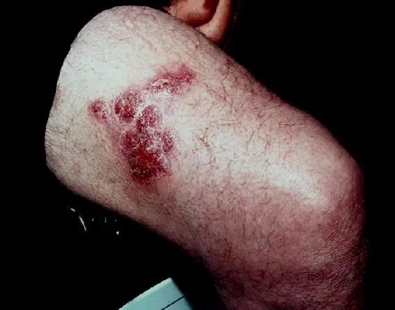 Blastomycosis cytology for diagnosis