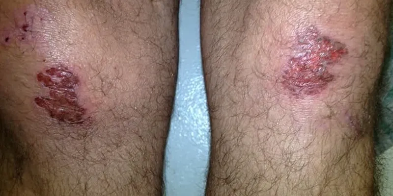 Blastomycosis definition and overview