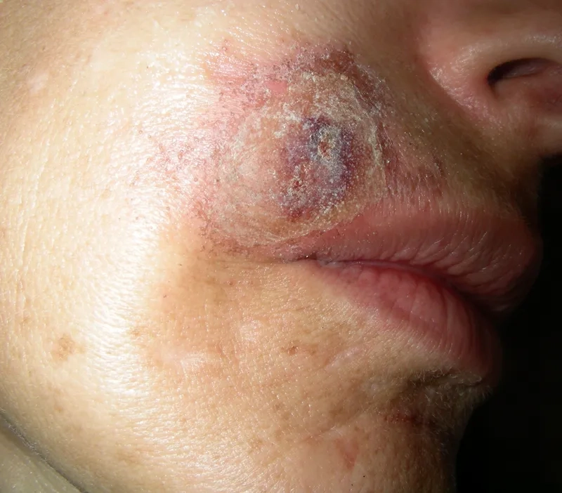 Blastomycosis on skin: visual identification