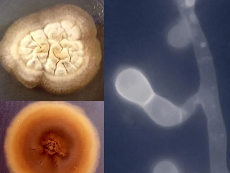 Blastomycosis in humans: understanding the infection