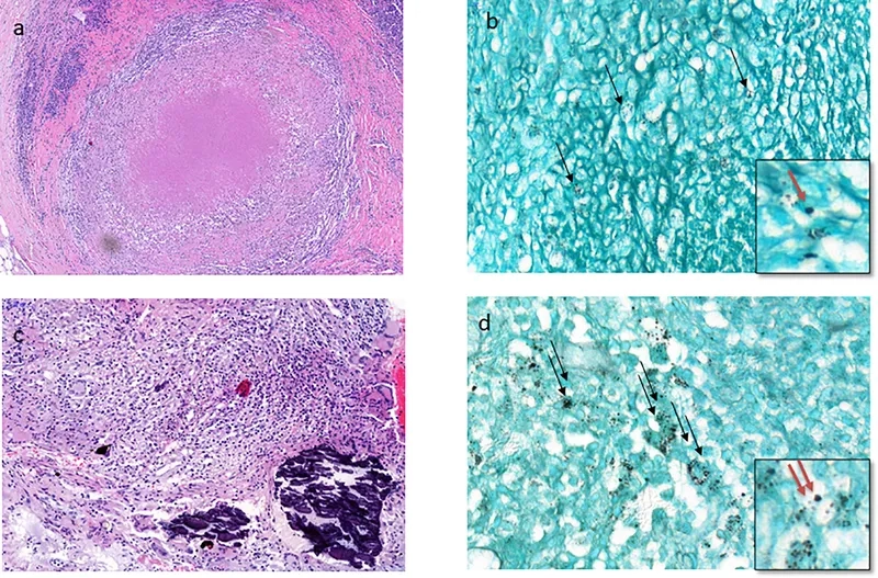 Blastomycosis fungi under microscope