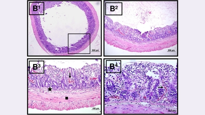 Bolivian Hemorrhagic Fever caused by Arenavirus