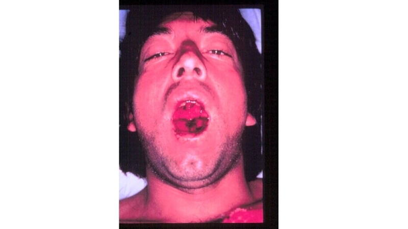 Bolivian Hemorrhagic Fever a viral hemorrhagic fever