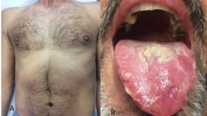 Bolivian Hemorrhagic Fever treatment options