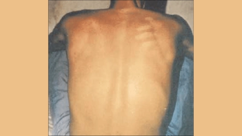 Bolivian Hemorrhagic Fever Junin virus related