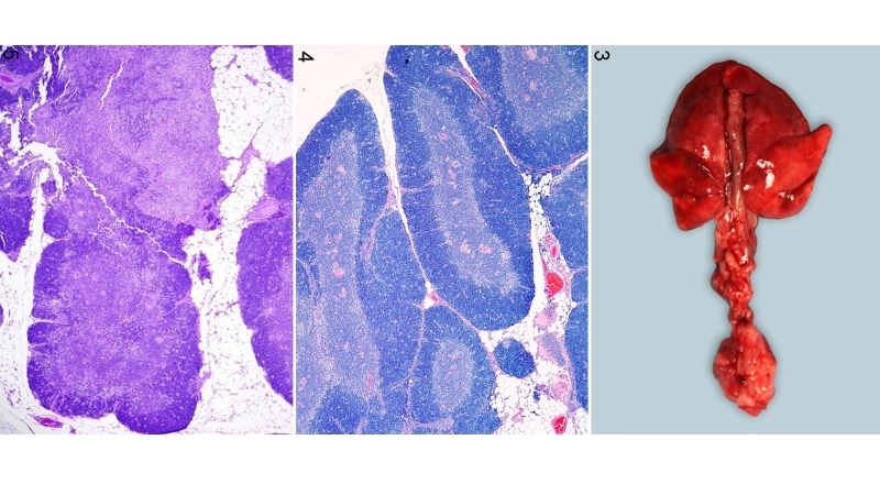 Bolivian Hemorrhagic Fever and Argentine Hemorrhagic Fever