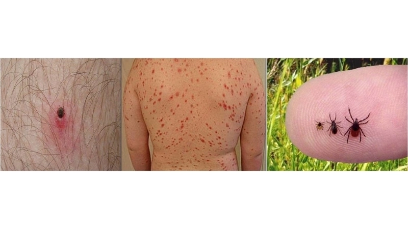 Bourbon Virus Disease linked to Bourbon virus