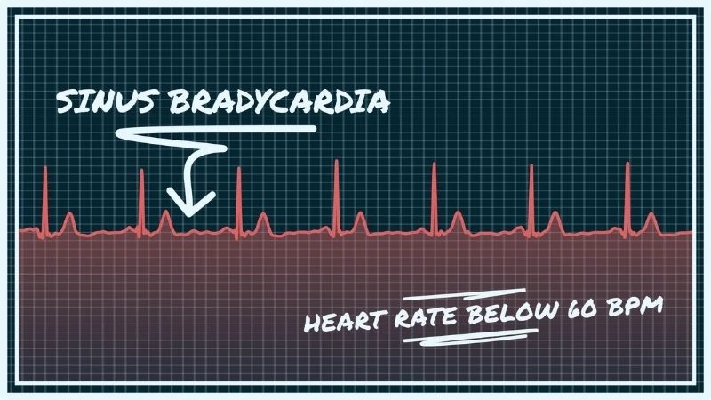 Bradycardia vs tachycardia shows slow versus fast heart rates