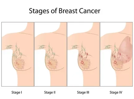 The distinct visual signs of inflammatory breast cancer