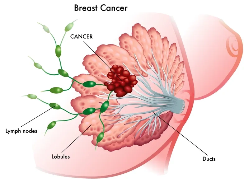 A visual guide to common breast cancer symptoms