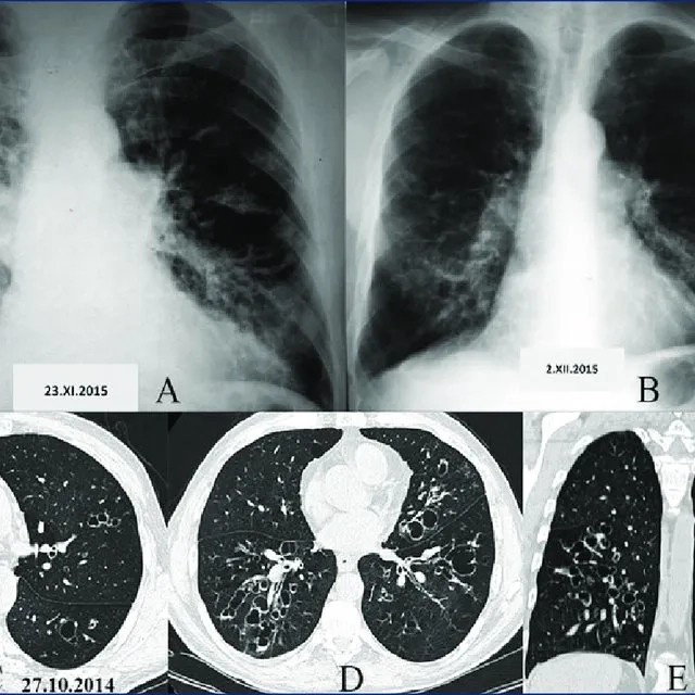Is bronchiectasis a disease of the lungs