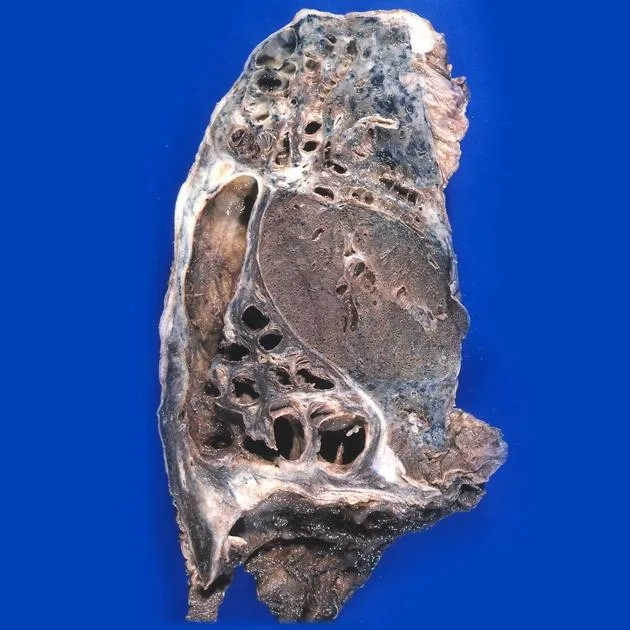 Can bronchiectasis be cured with treatment