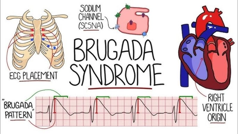 Brugada Syndrome Symptoms signal hidden heart danger