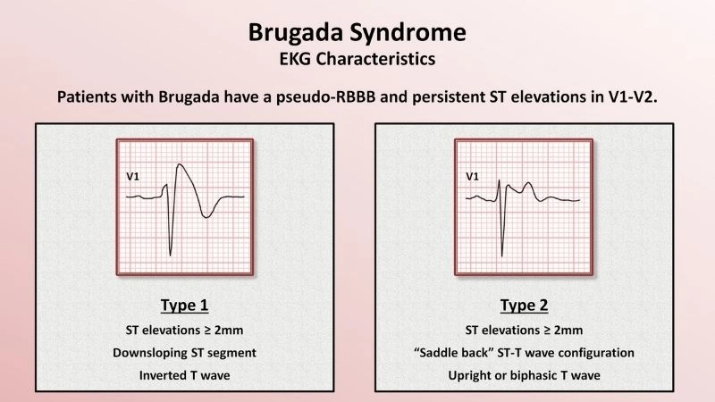 SCN5A Gene mutation causes dangerous heart signals