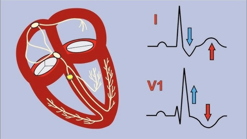 Bundle Branch Block ECG shows electrical heart change
