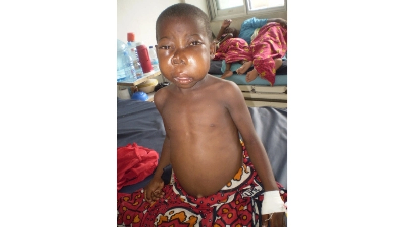 Immunodeficiency Burkitt's Lymphoma focus