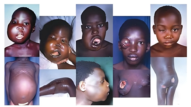 Burkitt's Lymphoma causes explained