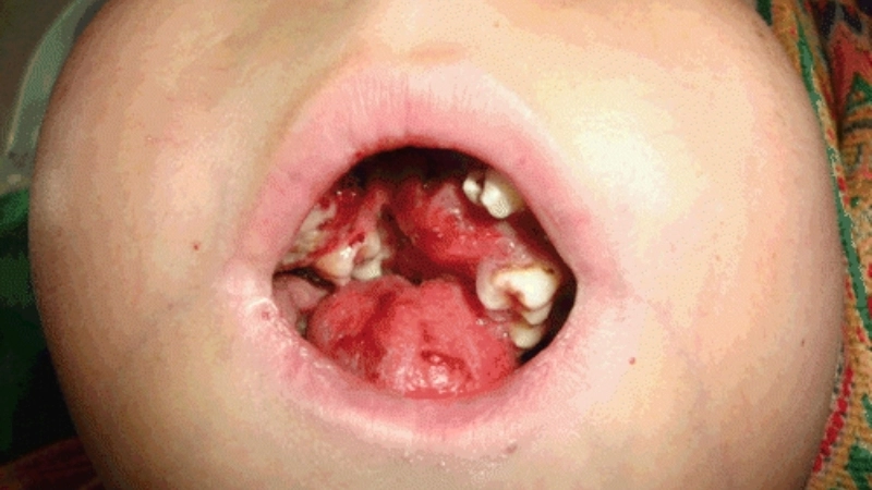 Sporadic Burkitt's Lymphoma facts