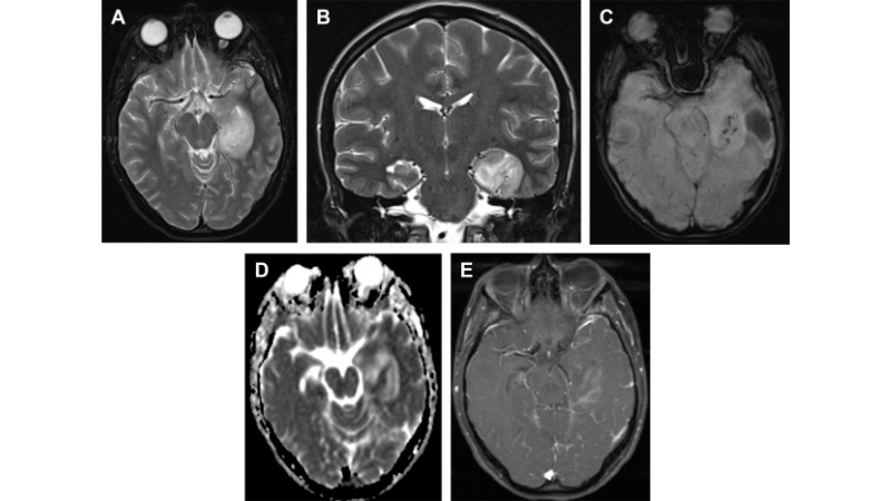Discover facts about California encephalitis virus