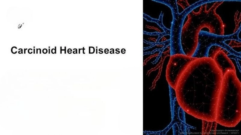Alarming signs of carcinoid heart disease symptoms