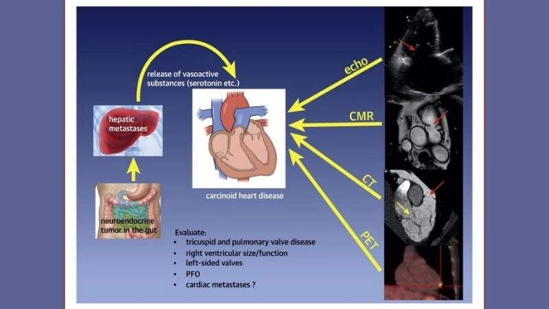 Hope in carcinoid heart disease patient support