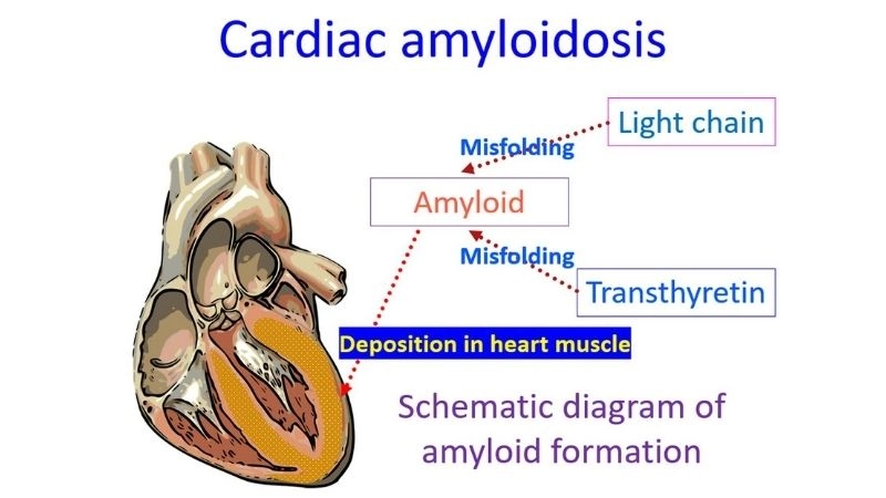 Serious risks in light chain amyloidosis