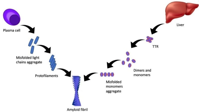 Understanding deadly amyloidosis heart disease