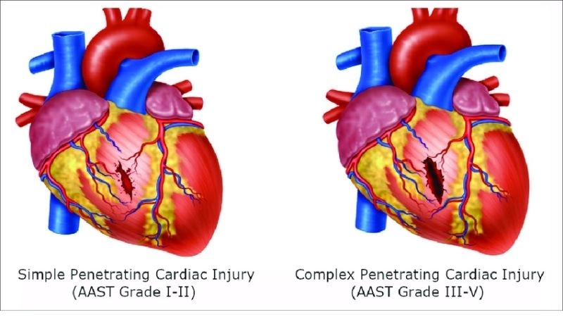 Dangers in blunt chest trauma heart injuries