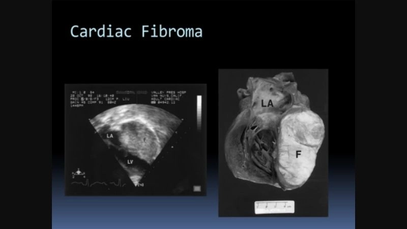 Visual comparison cardiac fibroma vs myxoma