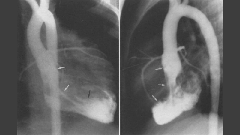 Detailed capture of fibroma heart tumor case