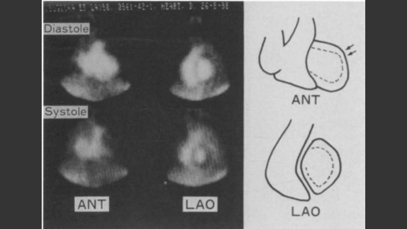 Exploring reality of fibroma of the heart risk
