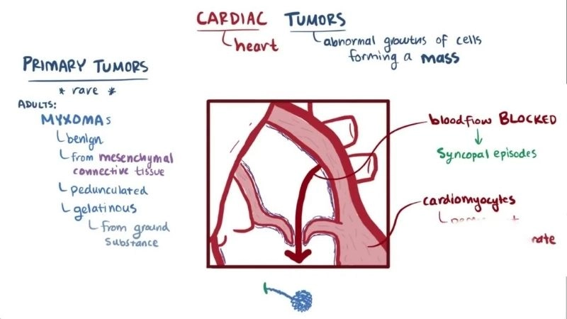 Left atrial myxoma most common location of cardiac tumor