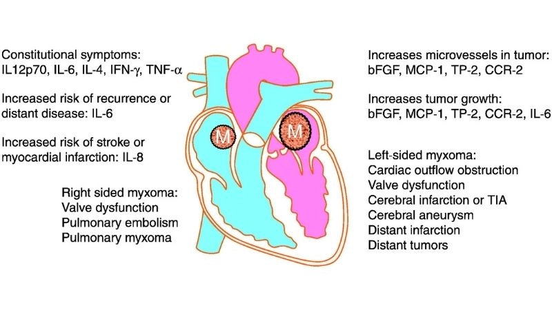 Cardiac myxoma surgery lifesaving procedure for removal