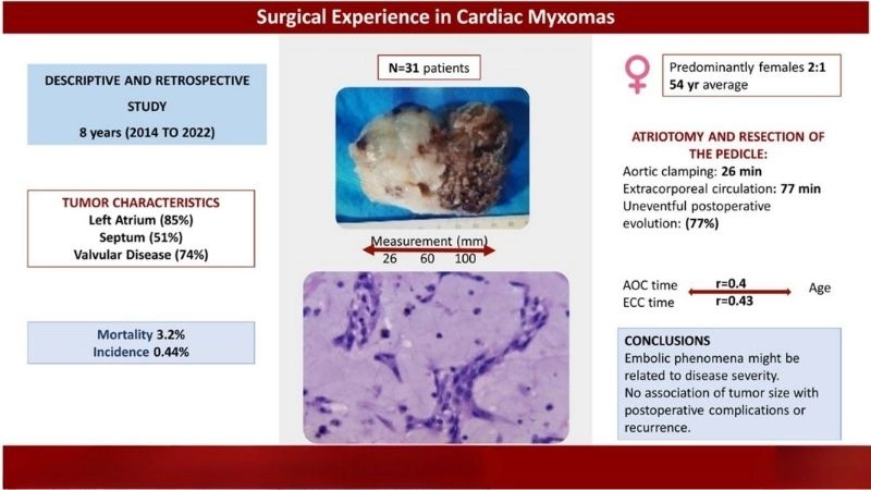 Myxoma diagnosis accurate detection of benign heart mass