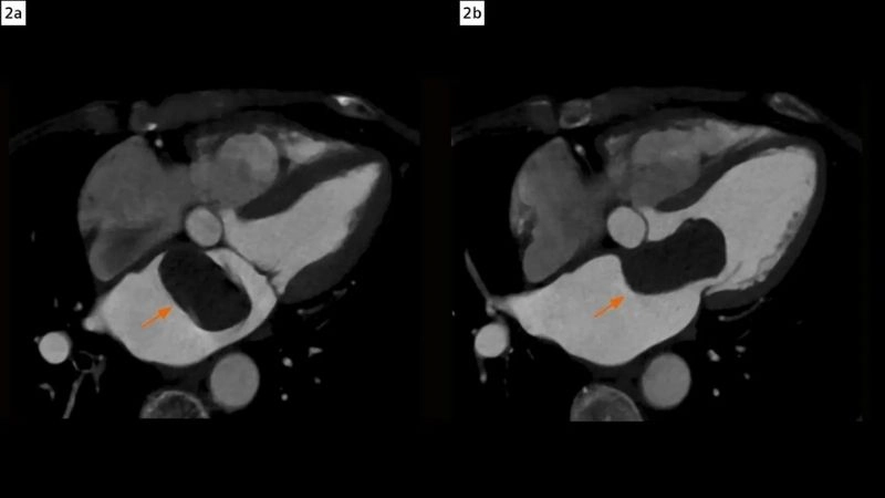 Cardiac myxoma causes underlying factors of tumor formation