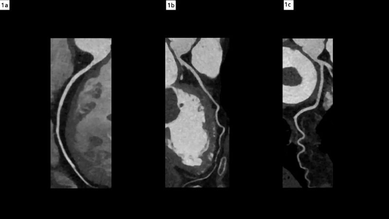 Myxoma vs thrombus differences between tumor and clot