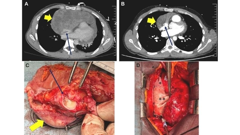 Cardiac sarcoma diagnosis accurate detection of malignant tumor