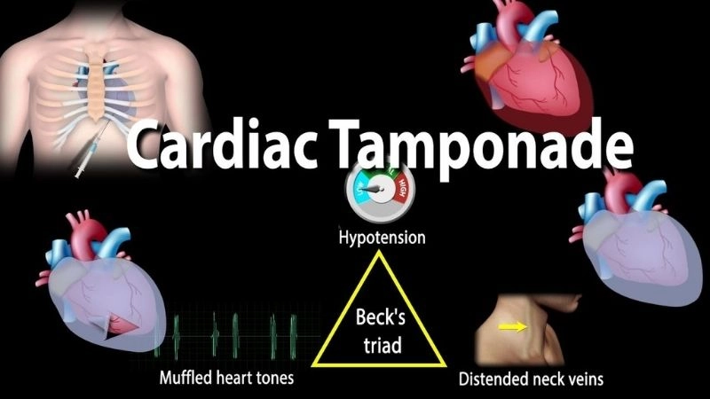 Cardiac tamponade symptoms warning signs of heart compression