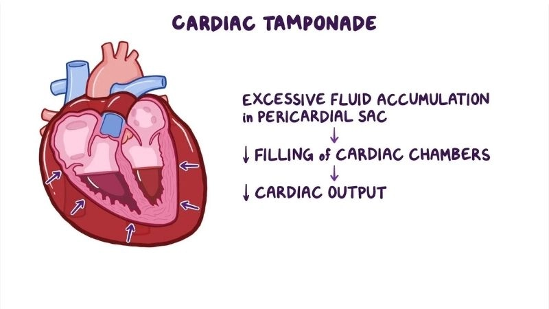 Pericardiocentesis lifesaving procedure to drain heart fluid