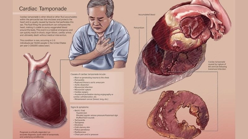 Cardiac tamponade diagnosis accurate detection for fast action