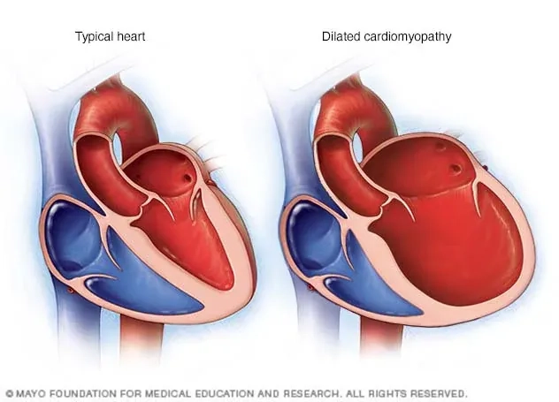 A diagram of a heart with dilated cardiomyopathy